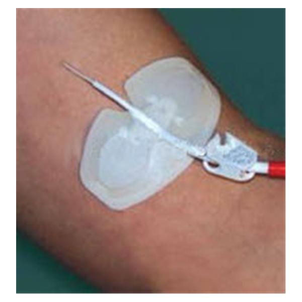 Device Catheter Securement WingGuard PICC Skin With Adhesive Back 100/Ca